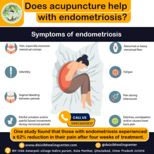 Does acupuncture help with endometriosis?