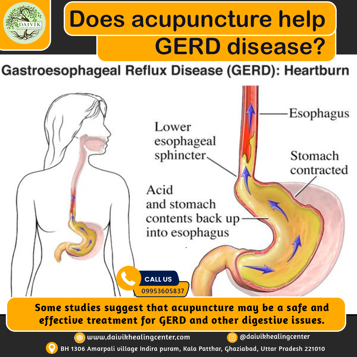 gerd disease with acupenture in indrapuram